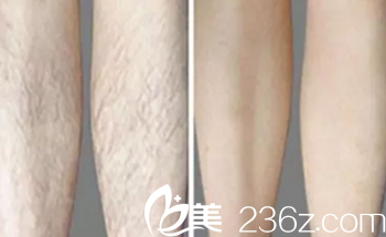 大同清木整形宋瑩潔激光脫毛案例