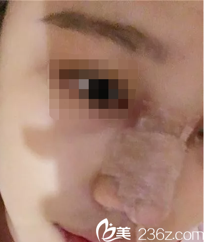 隆鼻手術當天效果 隆鼻手術當天效果