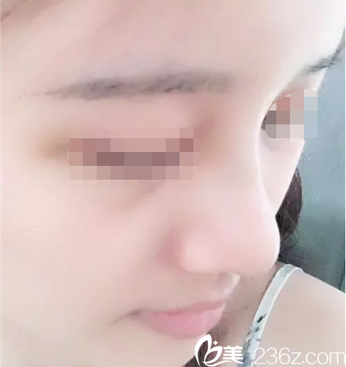 will醫(yī)院魏亨坤隆鼻手術術后第15天 will醫(yī)院魏亨坤隆鼻手術術后第15天