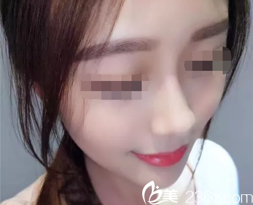 will醫(yī)院魏亨坤做鼻整形怎么樣？揭秘真實(shí)隆鼻案例