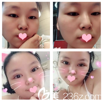 佛山夢(mèng)露整形美容醫(yī)院游萬(wàn)福雙眼皮案例 佛山夢(mèng)露整形美容醫(yī)院游萬(wàn)福雙眼皮案例