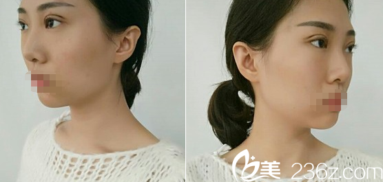 成都美極劉潔線雕雙眼皮術后1天恢復效果