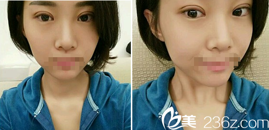 成都皇家美極劉潔埋線雙眼皮一周