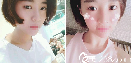 ?成都皇家美極整形醫(yī)院劉潔線雕雙眼皮術(shù)后5個(gè)月恢復(fù)過程全紀(jì)錄