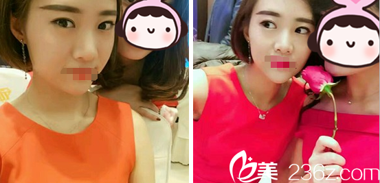 成美極劉潔雙眼皮術后10天化妝效果