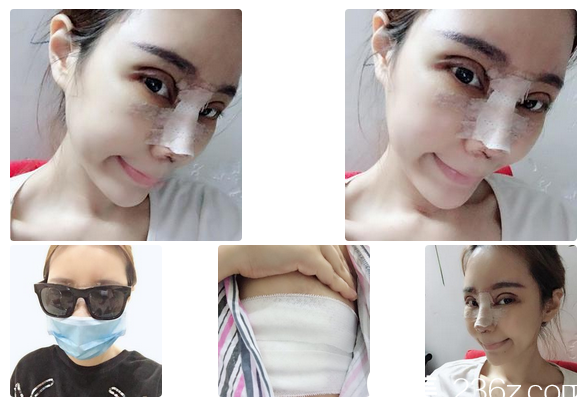 在佛山夢露醫(yī)院做完雙眼皮和隆鼻三天效果