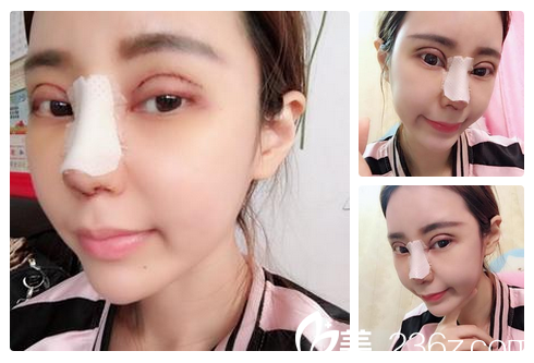 佛山夢露醫(yī)院游萬福雙眼皮隆鼻案例恢復(fù)期照片