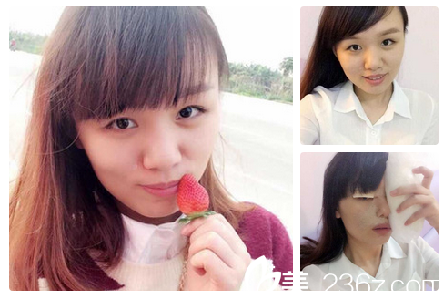 全切雙眼皮失敗照片 全切雙眼皮失敗照片