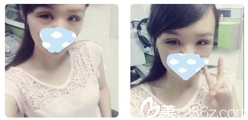 趙成利雙眼皮修復(fù) 趙成利雙眼皮修復(fù)