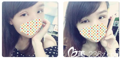 中山醫(yī)家庭整形醫(yī)院雙眼皮修復(fù)怎么樣 中山醫(yī)家庭整形醫(yī)院雙眼皮修復(fù)怎么樣