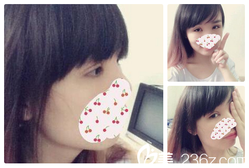 趙成利做雙眼皮修復(fù)怎么樣 趙成利做雙眼皮修復(fù)怎么樣