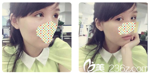 找趙成利做完雙眼皮修復(fù)第六天拆線<span style= 找趙成利做完雙眼皮修復(fù)第六天拆線<span style=