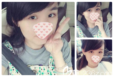 雙眼皮修復(fù)第13天記錄 雙眼皮修復(fù)第13天記錄