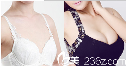 假體隆胸前后對比圖