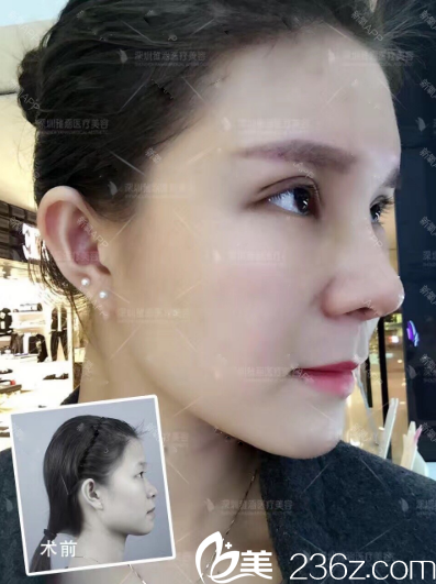 雙眼皮隆鼻前后對比照片 雙眼皮隆鼻前后對比照片