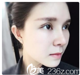 術(shù)后側(cè)面自拍 術(shù)后側(cè)面自拍