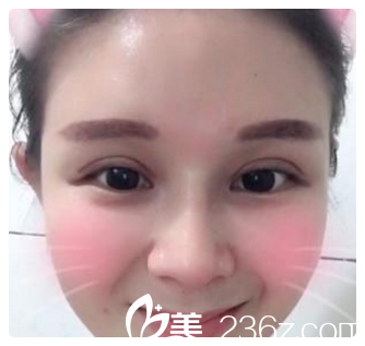 雙眼皮開內(nèi)眼角第九天<span style= 雙眼皮開內(nèi)眼角第九天<span style=