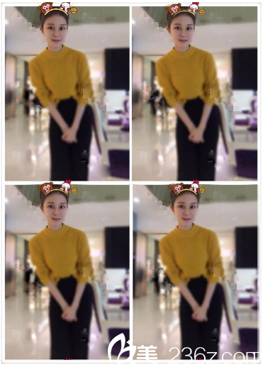 雙眼皮隆鼻術(shù)后一個(gè)月自拍 雙眼皮隆鼻術(shù)后一個(gè)月自拍