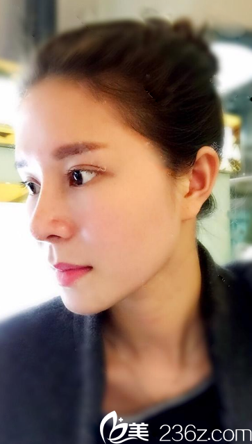 深圳雅涵高山做鼻子怎么樣？分享深圳隆鼻大王高山鼻綜合案例圖片