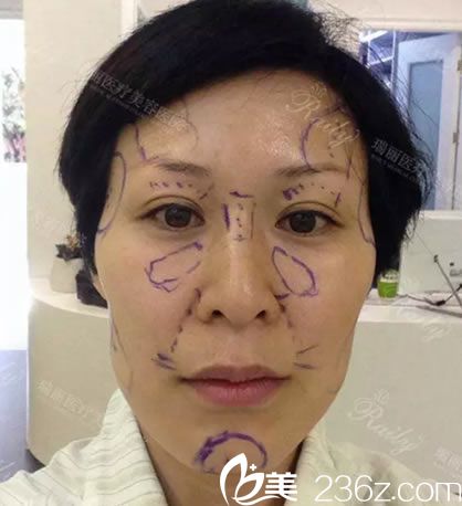 設(shè)計(jì)的面部脂肪填充方案 設(shè)計(jì)的面部脂肪填充方案