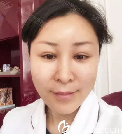 自體脂肪填充全臉3天的<span style= 自體脂肪填充全臉3天的<span style=