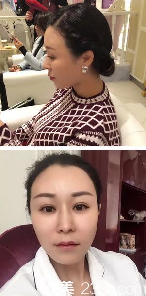 自體脂肪填充心形臉9個(gè)月<span style= 自體脂肪填充心形臉9個(gè)月<span style=