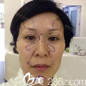 杭州瑞麗醫(yī)療美容醫(yī)院葉盛波術(shù)前照片1