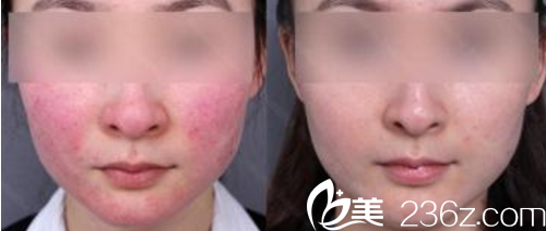 大同美神整形孟慶蘭祛紅血絲案例