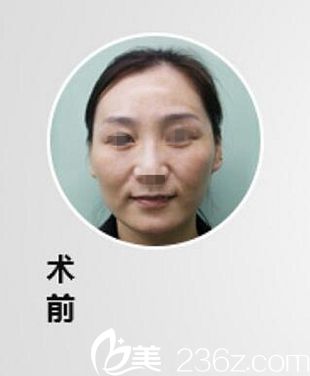漯河締美儷面部填充瘦臉術(shù)前 漯河締美儷面部填充瘦臉術(shù)前