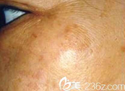 漯河締美儷激光祛斑 漯河締美儷激光祛斑