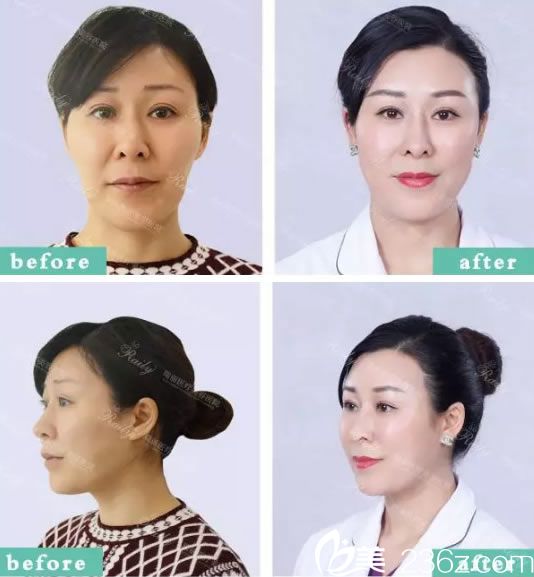 杭州瑞麗員工做自體脂肪填充效果