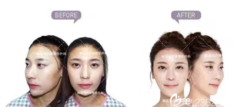 韓國毛杰琳發(fā)際線上移