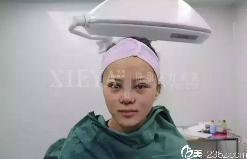 長沙協(xié)雅隆鼻+雙眼皮真人案例