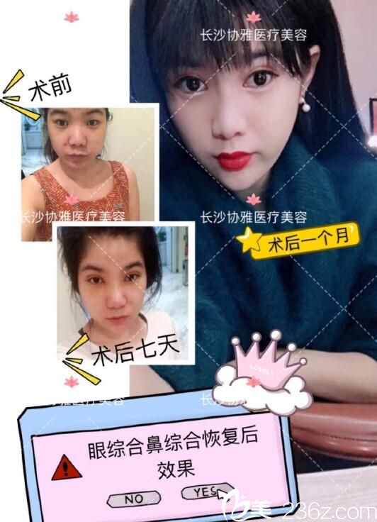 樊濤醫(yī)生打造的案例 長沙協(xié)雅 樊濤醫(yī)生打造的案例 長沙協(xié)雅