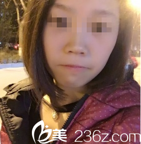 大同美神激光祛斑術(shù)后15天