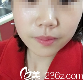 大同美神激光祛斑術(shù)后50天效果