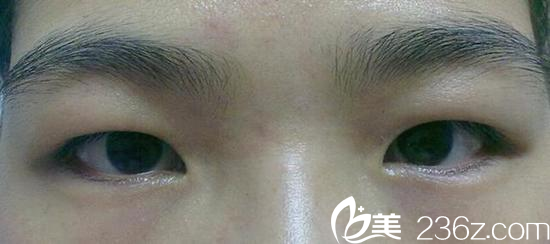 腫泡眼總給人感覺沒睡醒，沒精神