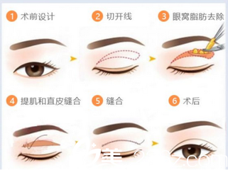 割雙眼皮能有效解決腫泡眼所帶來的眼部問題