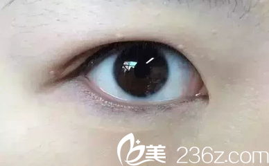 肌肉型腫泡眼通過割雙眼皮去除多余眼部匝肌改善腫泡眼