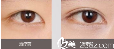 北京煤醫(yī)整形梁偉生雙眼皮案例 北京煤醫(yī)整形梁偉生雙眼皮案例