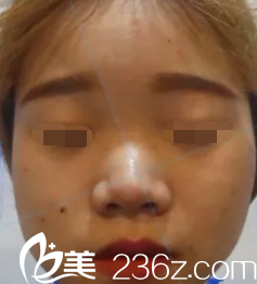 鼻綜合手術(shù)前的樣子