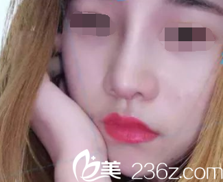 魏亨坤院長鼻綜合術(shù)后兩個月