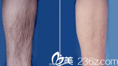 北京煤醫(yī)整形史芳醫(yī)生脫毛案例 北京煤醫(yī)整形史芳醫(yī)生脫毛案例