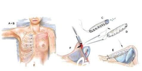 自體肋軟骨隆鼻取肋軟骨的部位