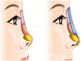 自體軟骨隆鼻前后對比