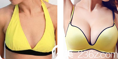 自體脂肪隆胸前后對比圖