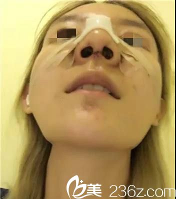 韓國(guó)will醫(yī)院隆鼻手術(shù)天