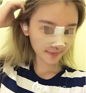 魏亨坤院長(zhǎng)鼻綜合手術(shù)第三天