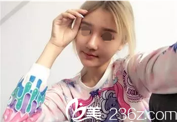 韓國(guó)will手術(shù)第二十天