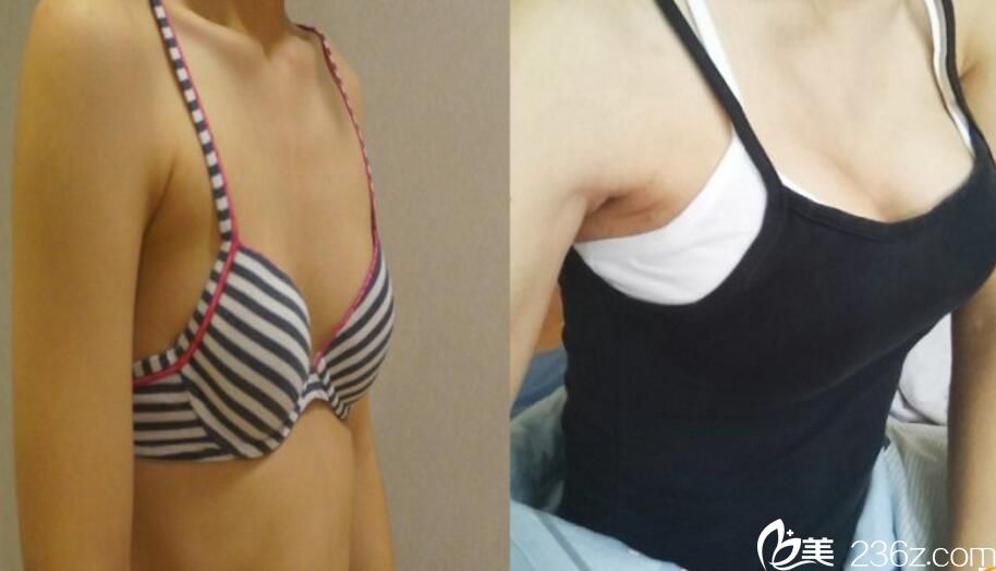 樸珉奭院長手術 - 隆胸前后對比照 樸珉奭院長手術 - 隆胸前后對比照